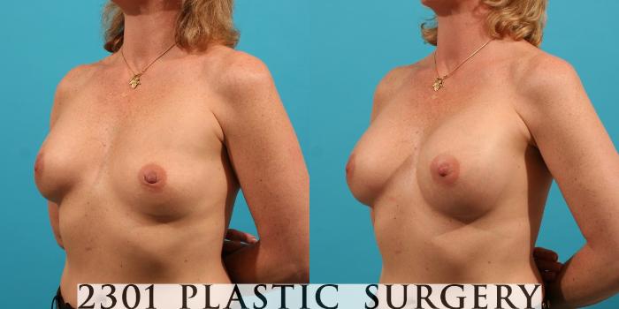 Before & After Saline Implants Case 28 View #3 View in Fort Worth, Plano, & Frisco, Texas