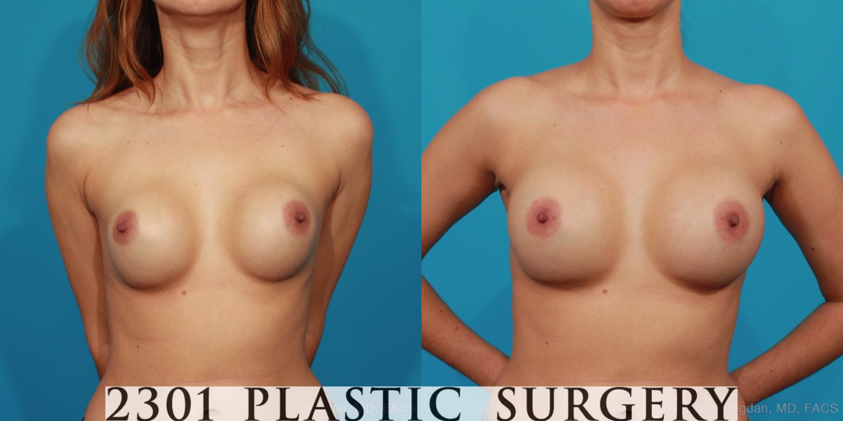Before & After Breast Augmentation Revision Case 283 View #1 View in Fort Worth & Frisco, Texas