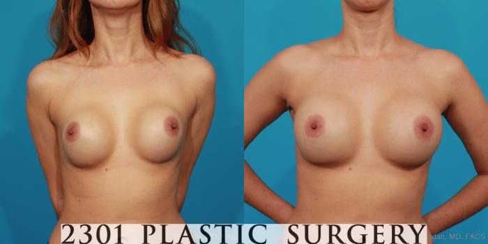 Before & After Breast Augmentation Revision Case 283 View #1 View in Fort Worth, Plano, & Frisco, Texas