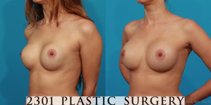 Before & After Breast Augmentation Revision Case 283 View #2 View in Fort Worth, Plano, & Frisco, Texas