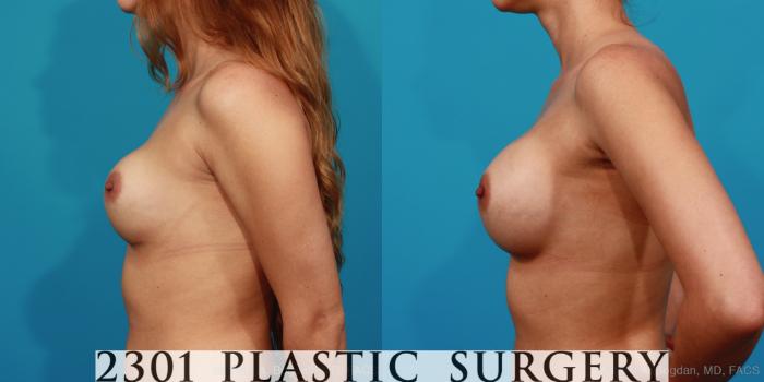 Before & After Breast Augmentation Revision Case 283 View #3 View in Fort Worth, Plano, & Frisco, Texas