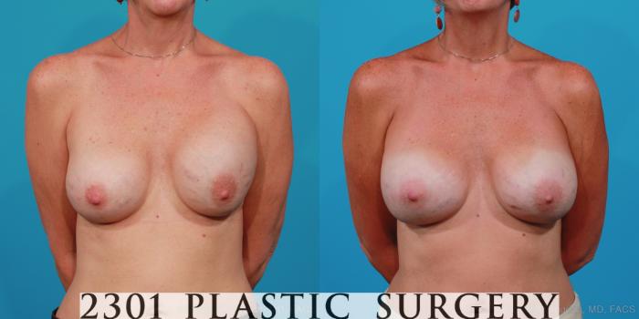 Before & After Breast Augmentation Revision Case 286 View #1 View in Fort Worth, Plano, & Frisco, Texas