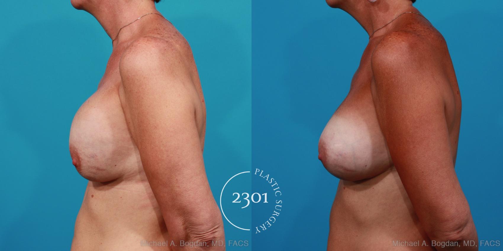 Before & After Breast Augmentation Revision Case 286 View #2 View in Fort Worth, Plano, & Frisco, Texas