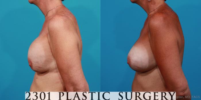 Before & After Breast Augmentation Revision Case 286 View #2 View in Fort Worth, Plano, & Frisco, Texas