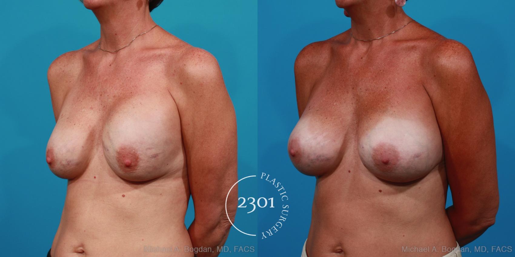Before & After Breast Augmentation Revision Case 286 View #3 View in Fort Worth, Plano, & Frisco, Texas