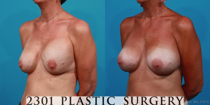 Before & After Breast Augmentation Revision Case 286 View #3 View in Fort Worth, Plano, & Frisco, Texas