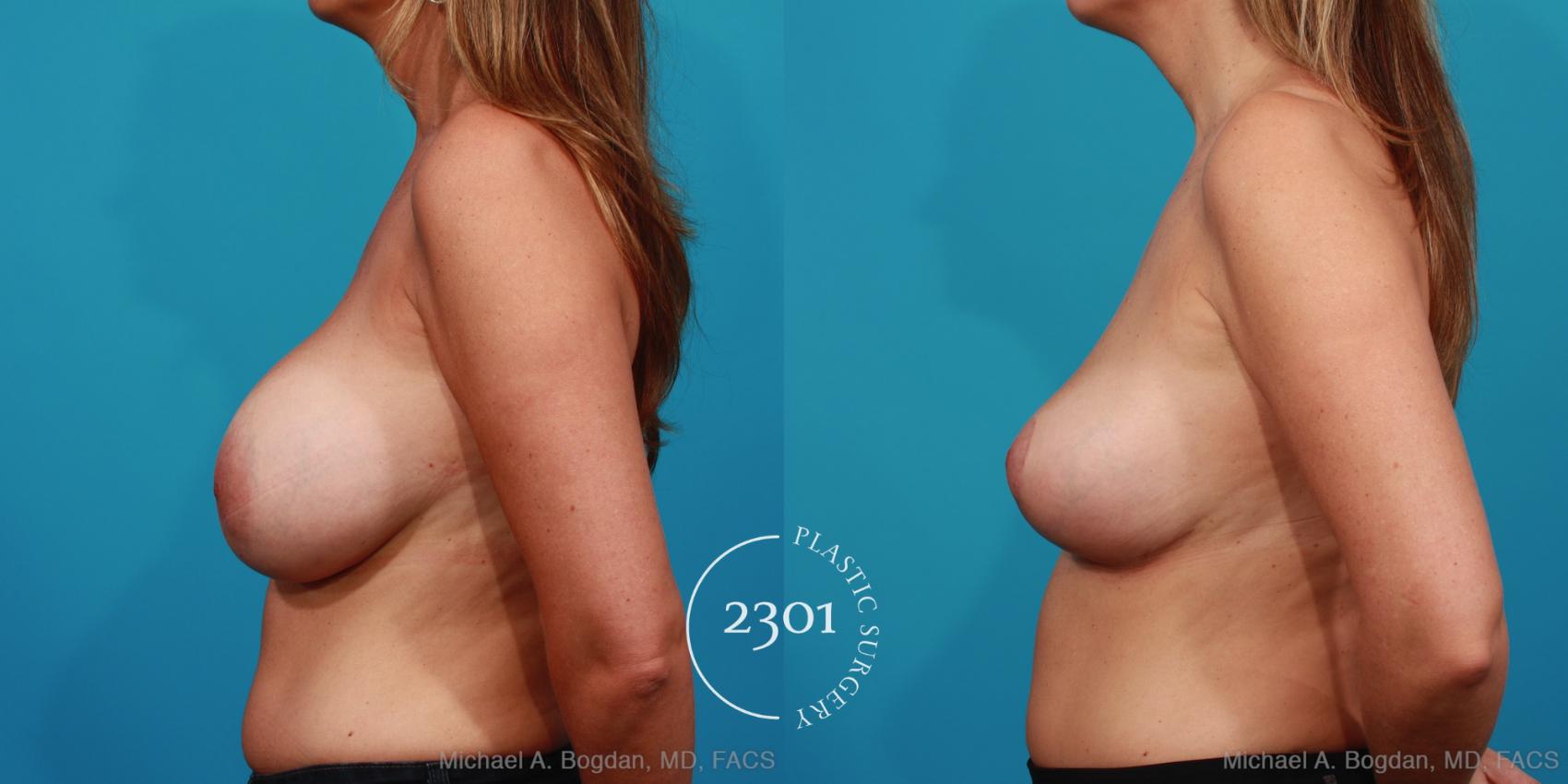 Before & After Breast Augmentation Revision Case 326 View #2 View in Fort Worth, Plano, & Frisco, Texas