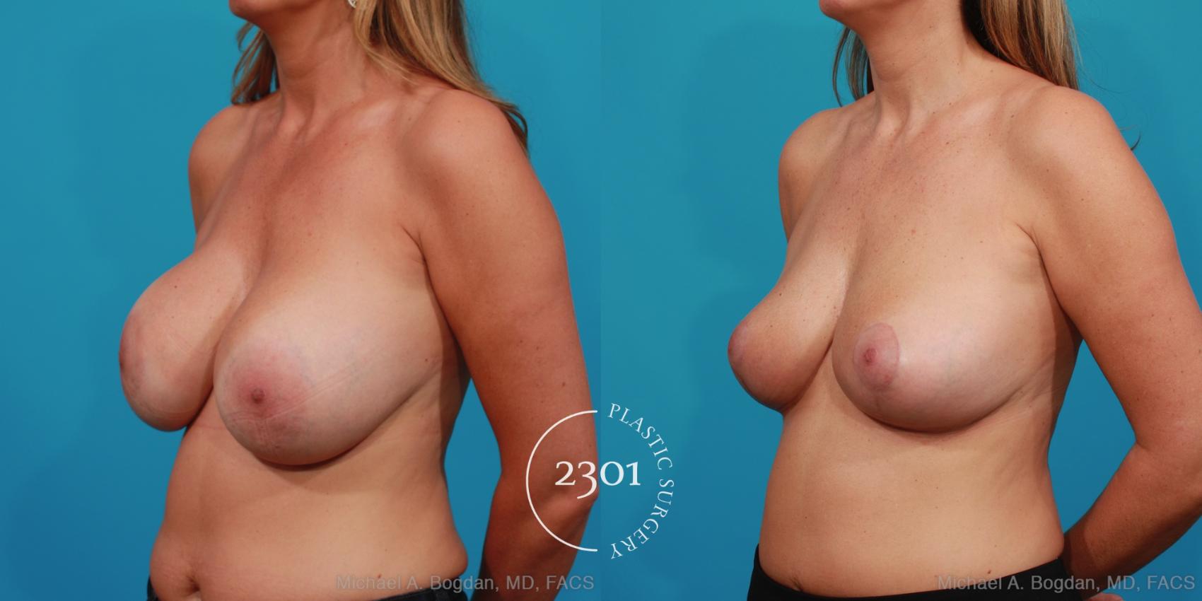 Before & After Breast Augmentation Revision Case 326 View #3 View in Fort Worth, Plano, & Frisco, Texas