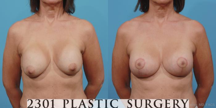 Before & After Breast Augmentation Revision Case 361 View #1 View in Fort Worth, Plano, & Frisco, Texas