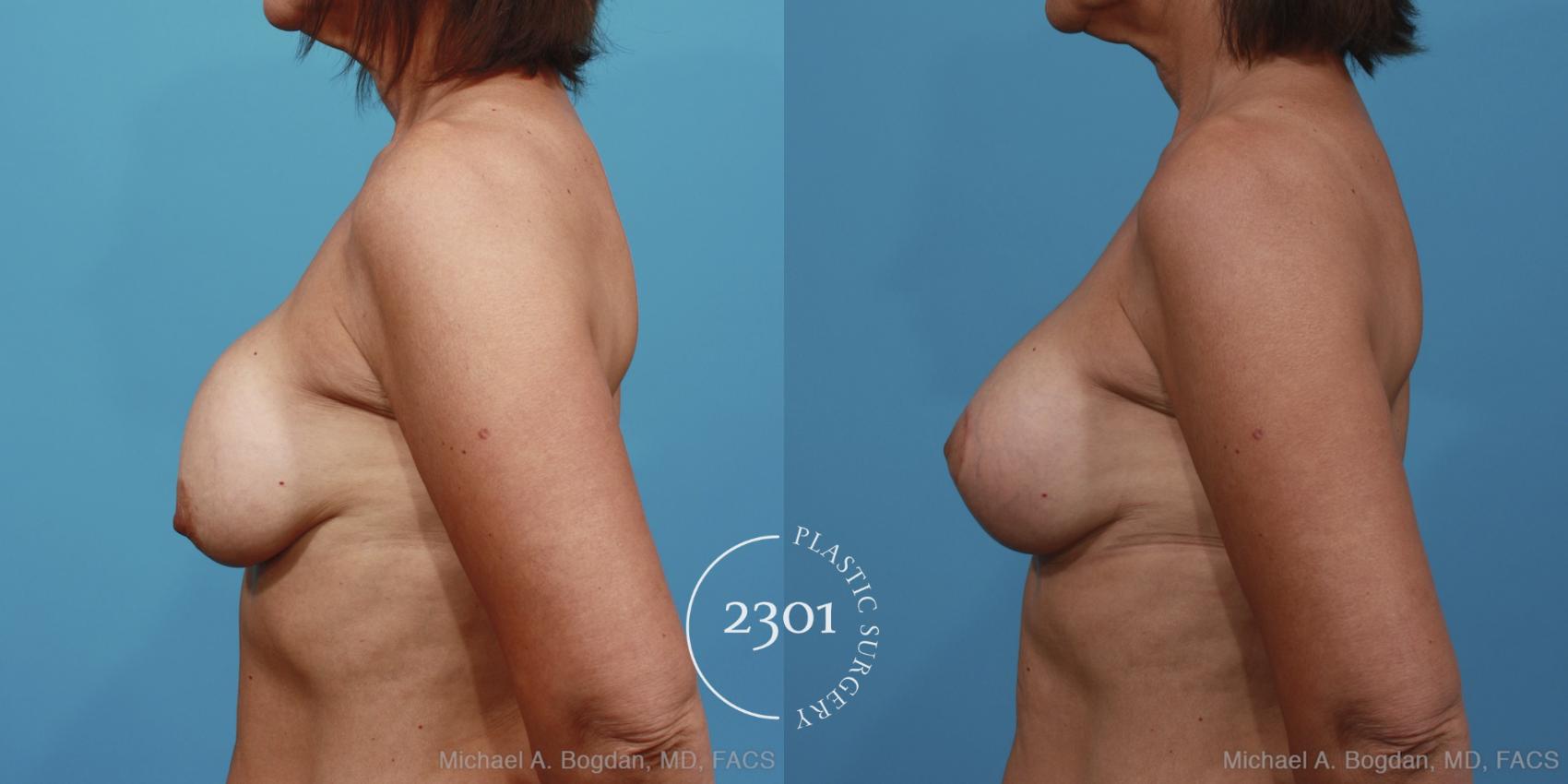 Before & After Breast Augmentation Revision Case 361 View #2 View in Fort Worth, Plano, & Frisco, Texas