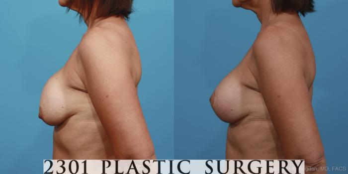 Before & After Breast Augmentation Revision Case 361 View #2 View in Fort Worth, Plano, & Frisco, Texas