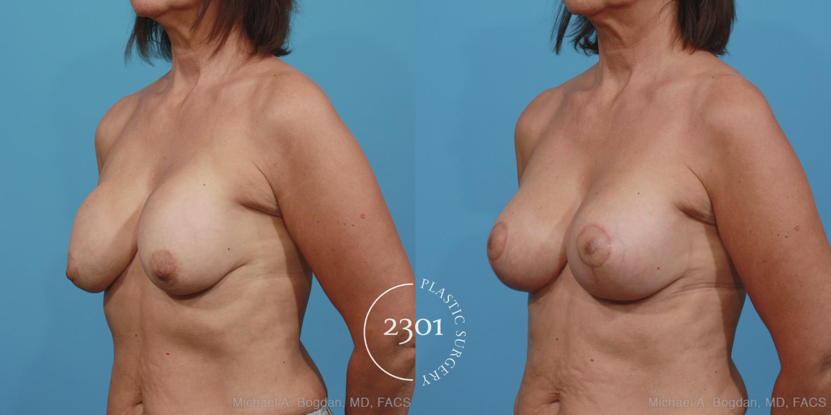 Before & After Breast Augmentation Revision Case 361 View #3 View in Fort Worth, Plano, & Frisco, Texas