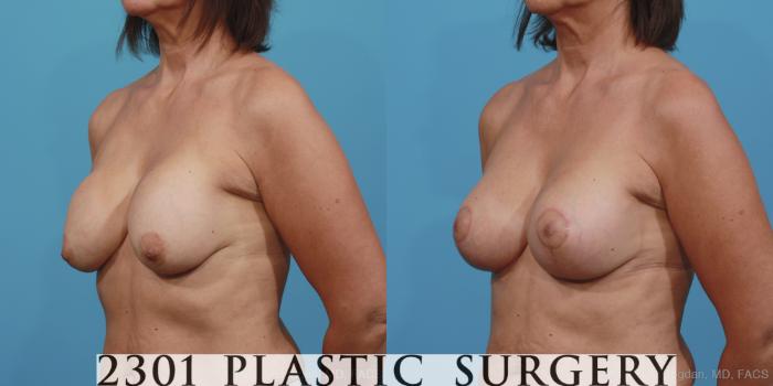 Before & After Breast Augmentation Revision Case 361 View #3 View in Fort Worth, Plano, & Frisco, Texas