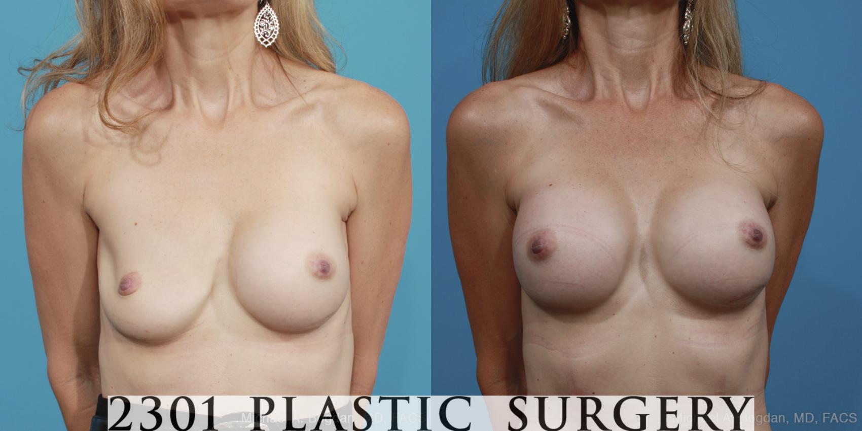 Before & After Breast Augmentation Revision Case 366 View #1 View in Fort Worth, Plano, & Frisco, Texas