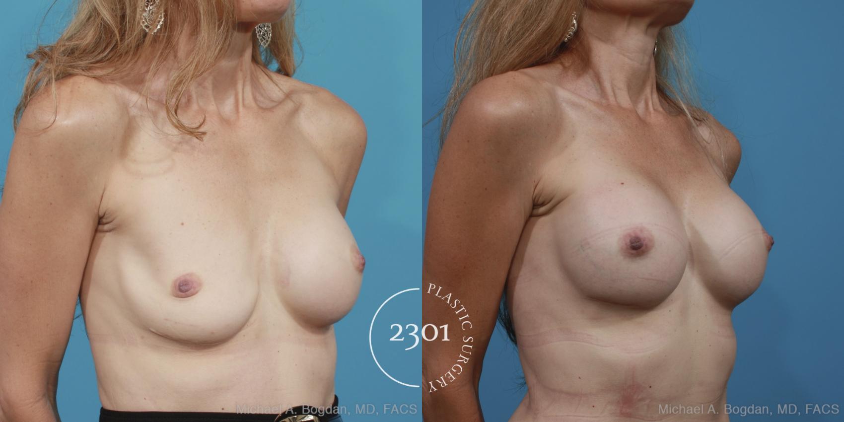 Before & After Breast Augmentation Revision Case 366 View #3 View in Fort Worth, Plano, & Frisco, Texas