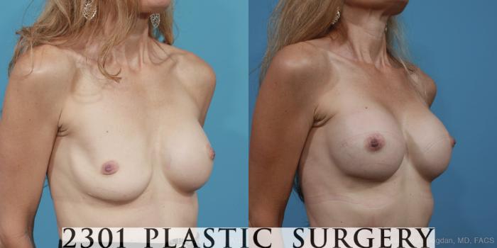 Before & After Breast Augmentation Revision Case 366 View #3 View in Fort Worth, Plano, & Frisco, Texas
