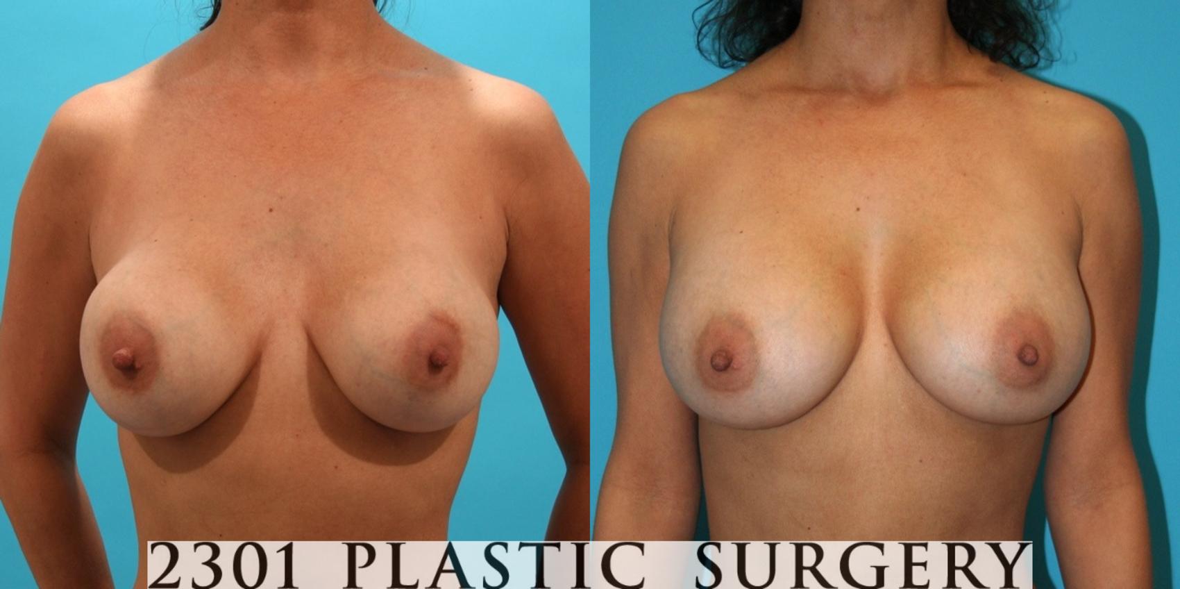 Before & After Breast Augmentation Revision Case 4 View #1 View in Fort Worth & Frisco, Texas