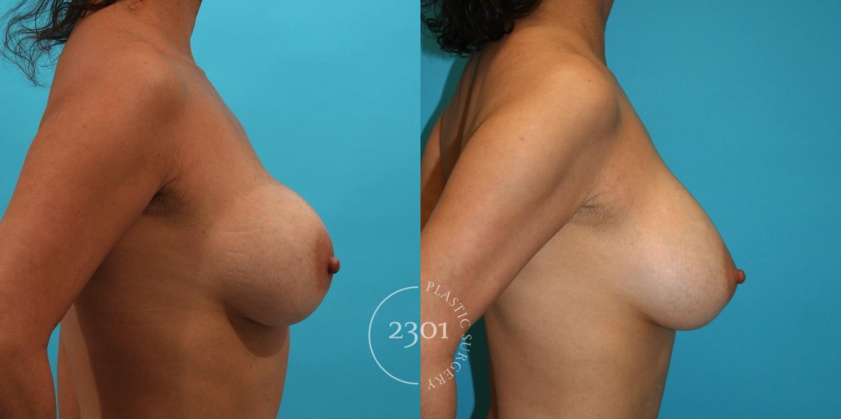 Before & After Breast Augmentation Revision Case 4 View #2 View in Fort Worth, Plano, & Frisco, Texas