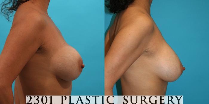 Before & After Breast Augmentation Revision Case 4 View #2 View in Fort Worth, Plano, & Frisco, Texas