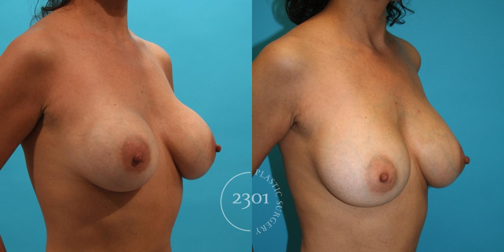 Before & After Breast Augmentation Revision Case 4 View #3 View in Fort Worth, Plano, & Frisco, Texas