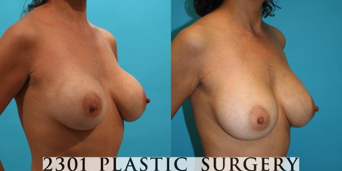 Before & After Silicone Implants Case 4 View #3 View in Fort Worth, Plano, & Frisco, Texas
