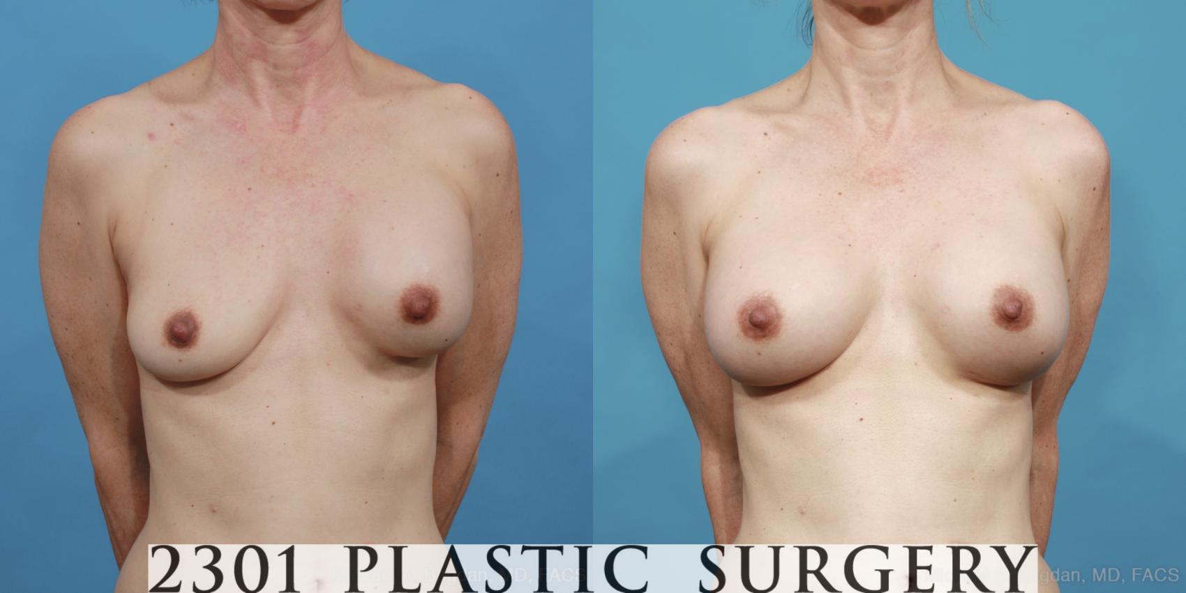 Before & After Breast Augmentation Revision Case 415 View #1 View in Fort Worth & Frisco, Texas