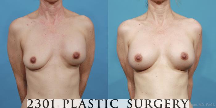 Before & After Breast Augmentation Revision Case 415 View #1 View in Fort Worth, Plano, & Frisco, Texas