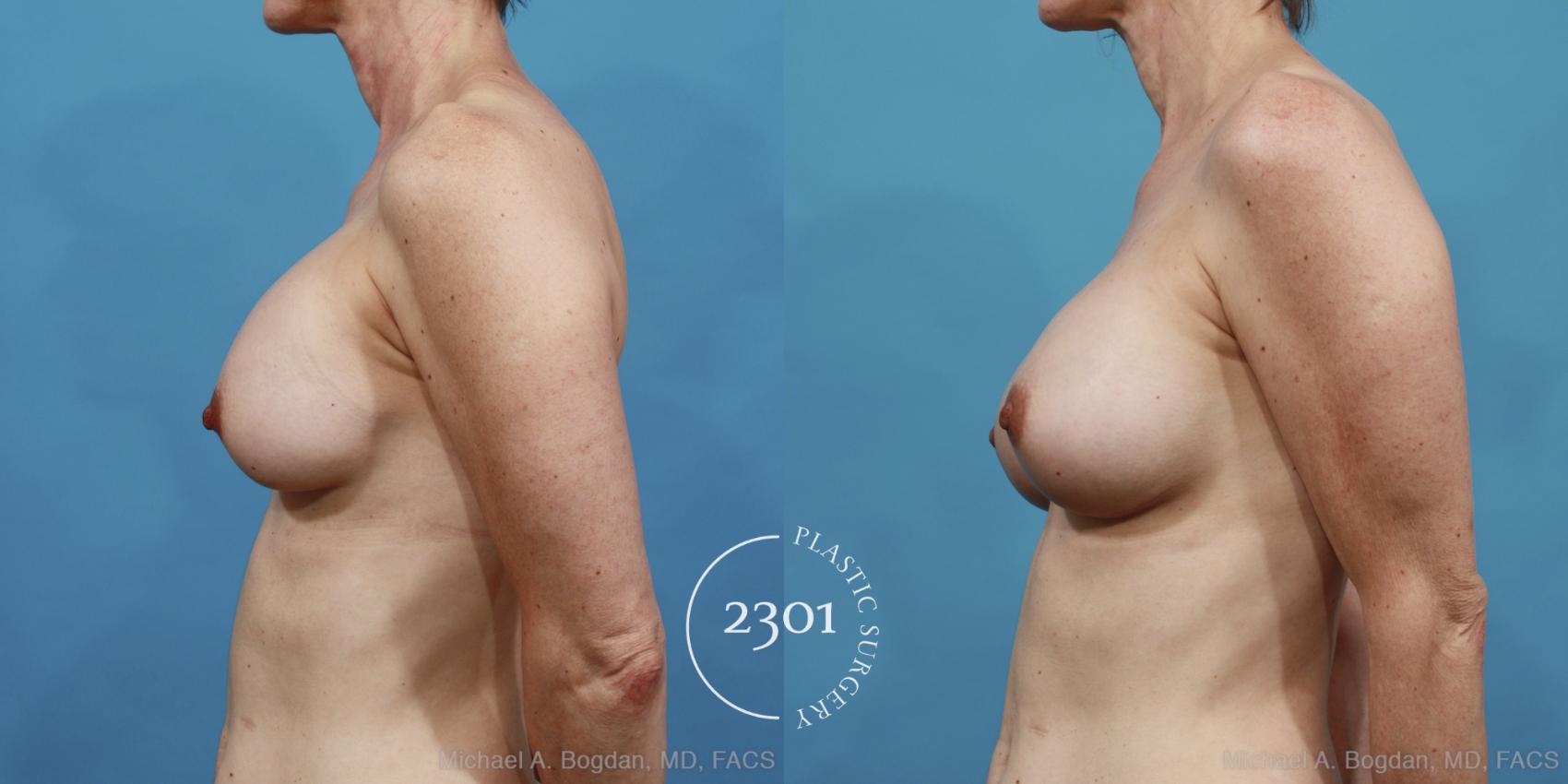 Before & After Breast Augmentation Revision Case 415 View #2 View in Fort Worth, Plano, & Frisco, Texas