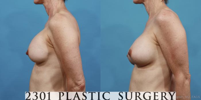 Before & After Breast Augmentation Revision Case 415 View #2 View in Fort Worth, Plano, & Frisco, Texas