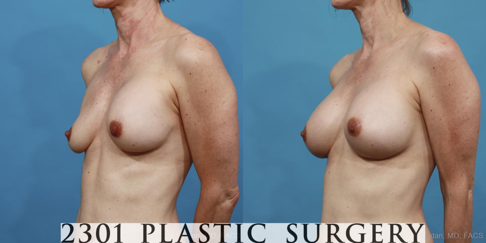 Before & After Breast Augmentation Revision Case 415 View #3 View in Fort Worth & Frisco, Texas