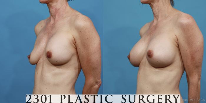 Before & After Breast Augmentation Revision Case 415 View #3 View in Fort Worth, Plano, & Frisco, Texas