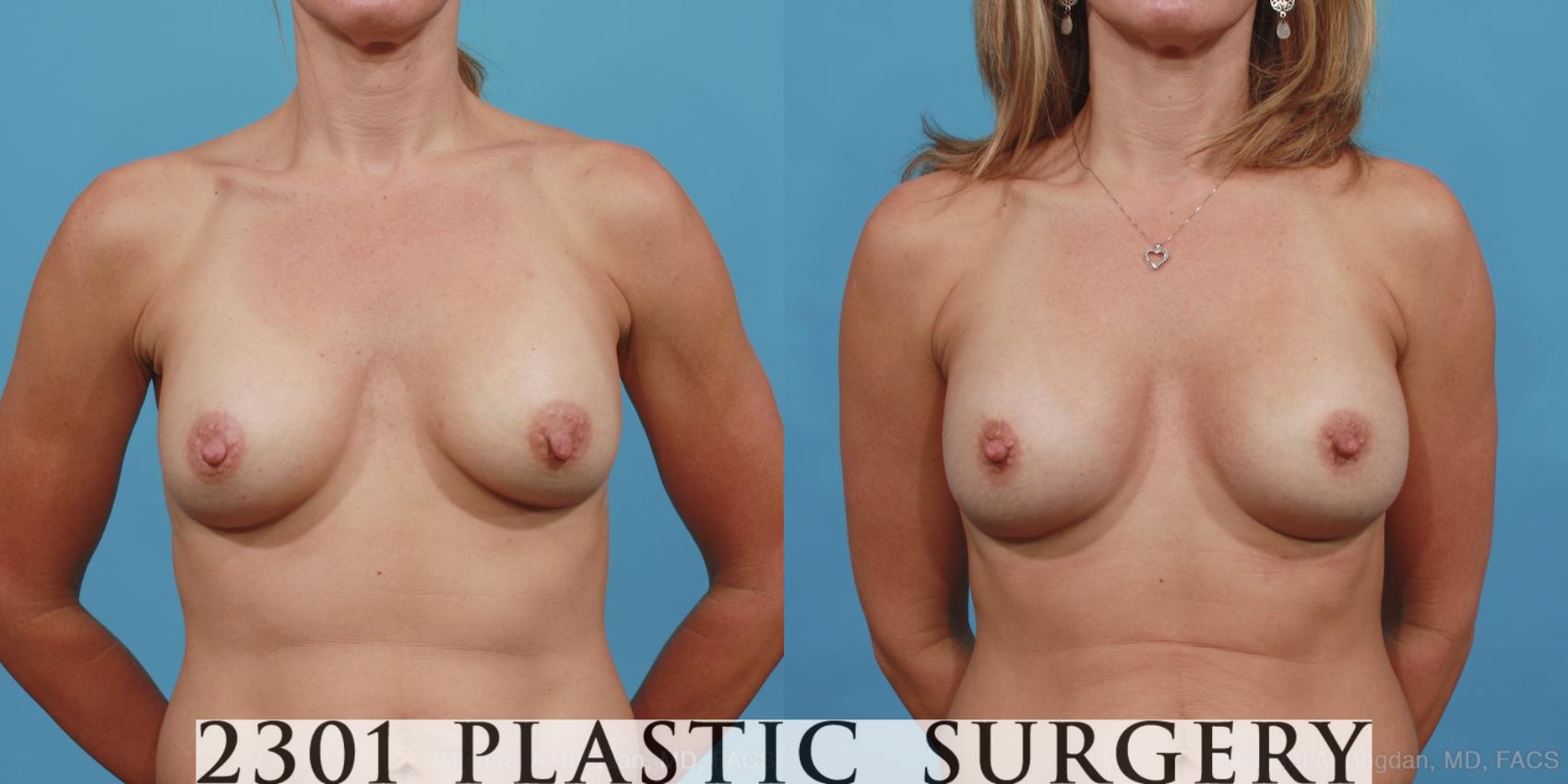 Before & After Breast Augmentation Revision Case 425 View #1 View in Fort Worth & Frisco, Texas