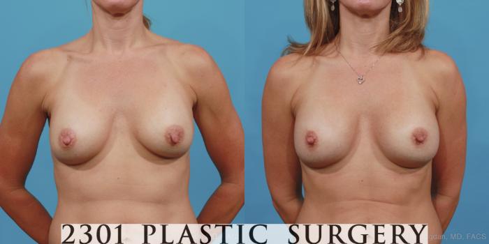 Before & After Breast Augmentation Revision Case 425 View #1 View in Fort Worth, Plano, & Frisco, Texas