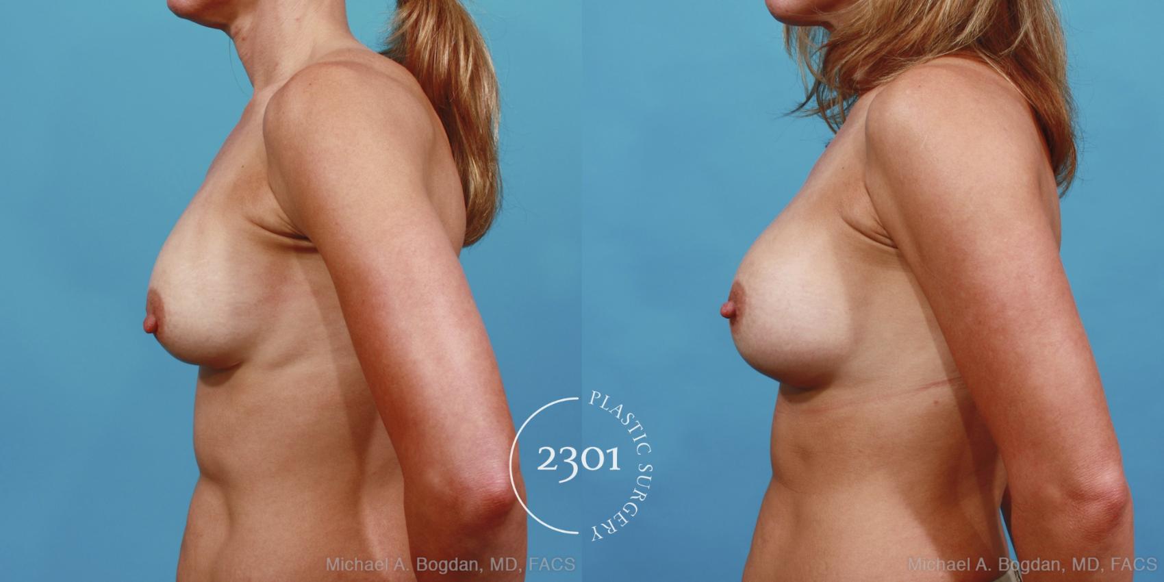Before & After Breast Augmentation Revision Case 425 View #2 View in Fort Worth, Plano, & Frisco, Texas