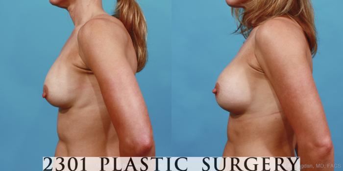 Before & After Breast Augmentation Revision Case 425 View #2 View in Fort Worth, Plano, & Frisco, Texas