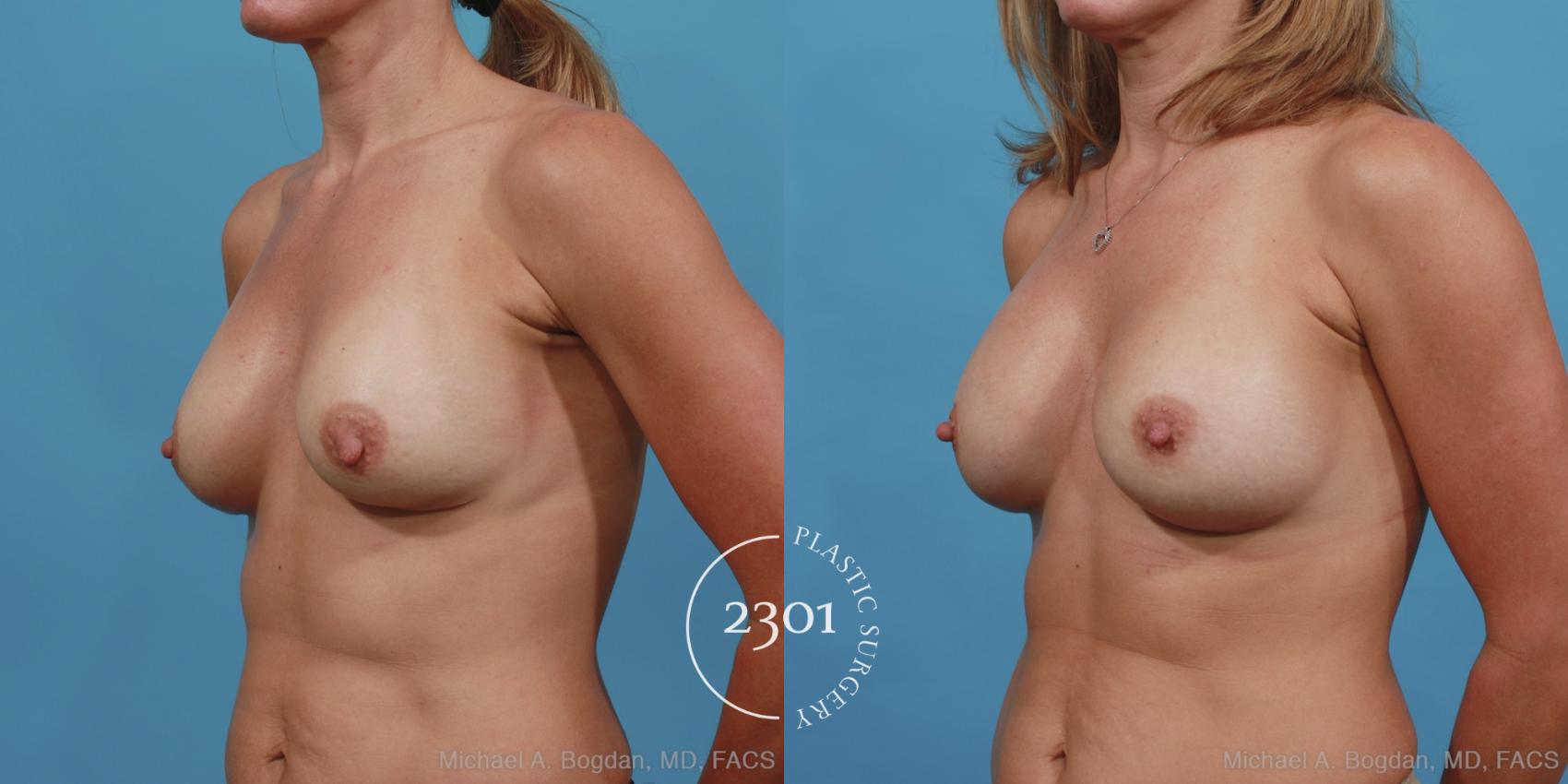 Before & After Breast Augmentation Revision Case 425 View #3 View in Fort Worth, Plano, & Frisco, Texas