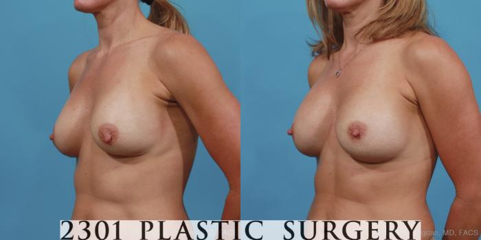 Before & After Breast Augmentation Revision Case 425 View #3 View in Fort Worth, Plano, & Frisco, Texas