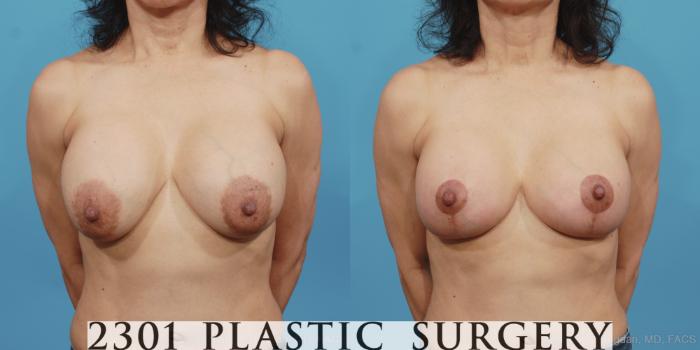 Before & After Breast Augmentation Revision Case 426 View #1 View in Fort Worth, Plano, & Frisco, Texas