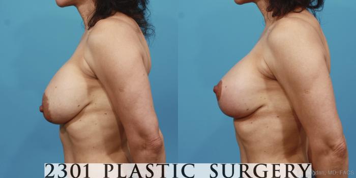 Before & After Breast Augmentation Revision Case 426 View #2 View in Fort Worth, Plano, & Frisco, Texas