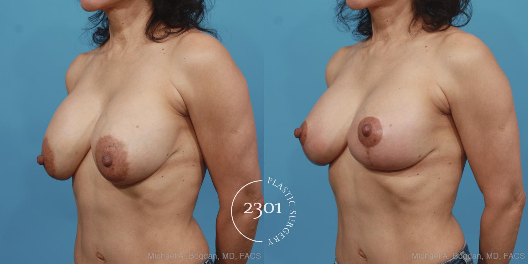 Before & After Breast Augmentation Revision Case 426 View #3 View in Fort Worth, Plano, & Frisco, Texas