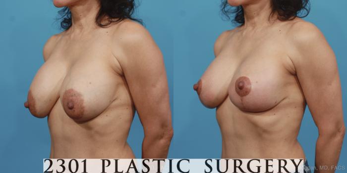 Before & After Breast Augmentation Revision Case 426 View #3 View in Fort Worth, Plano, & Frisco, Texas