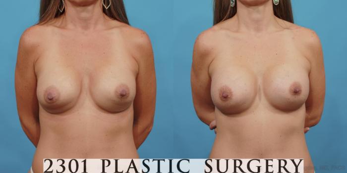 Before & After Breast Augmentation Revision Case 485 View #1 View in Fort Worth, Plano, & Frisco, Texas