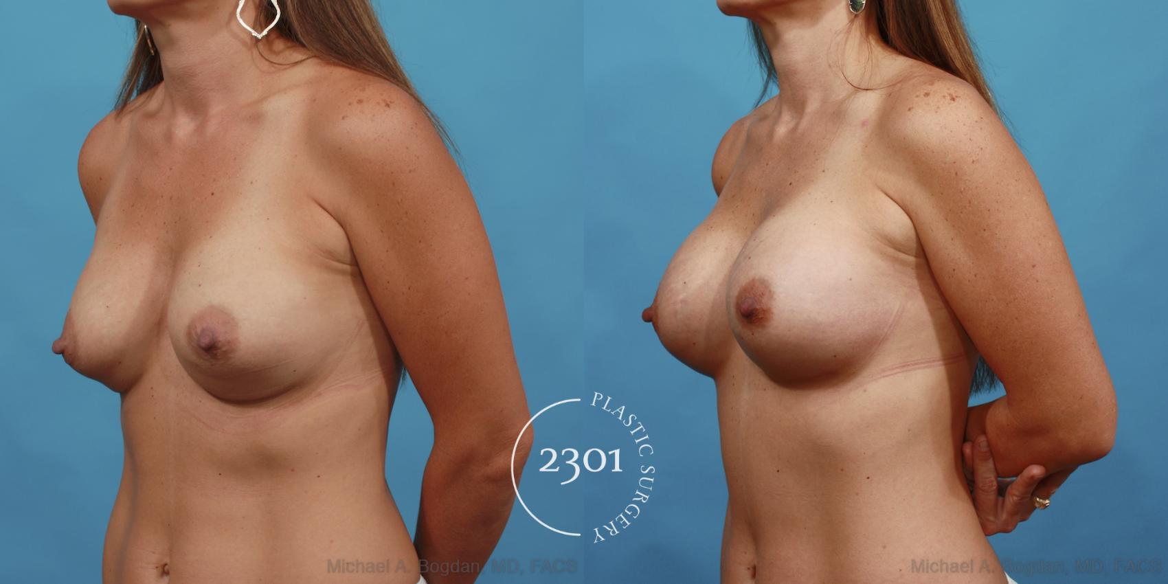 Before & After Silicone Implants Case 485 View #2 View in Fort Worth, Plano, & Frisco, Texas