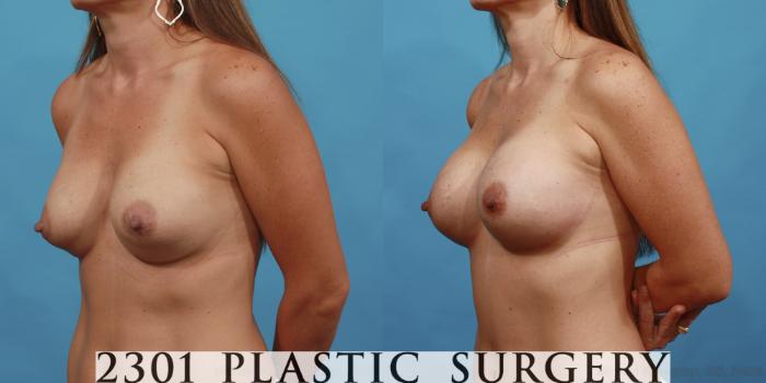 Before & After Silicone Implants Case 485 View #2 View in Fort Worth, Plano, & Frisco, Texas