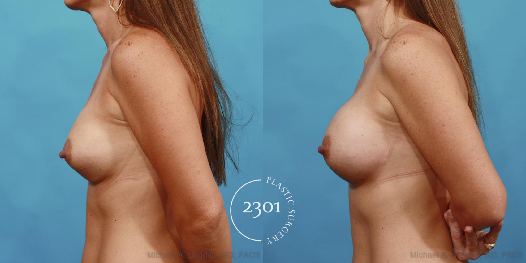 Before & After Silicone Implants Case 485 View #3 View in Fort Worth, Plano, & Frisco, Texas
