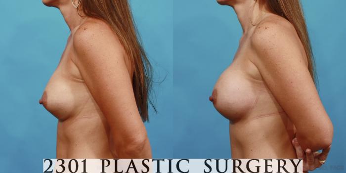 Before & After Silicone Implants Case 485 View #3 View in Fort Worth, Plano, & Frisco, Texas