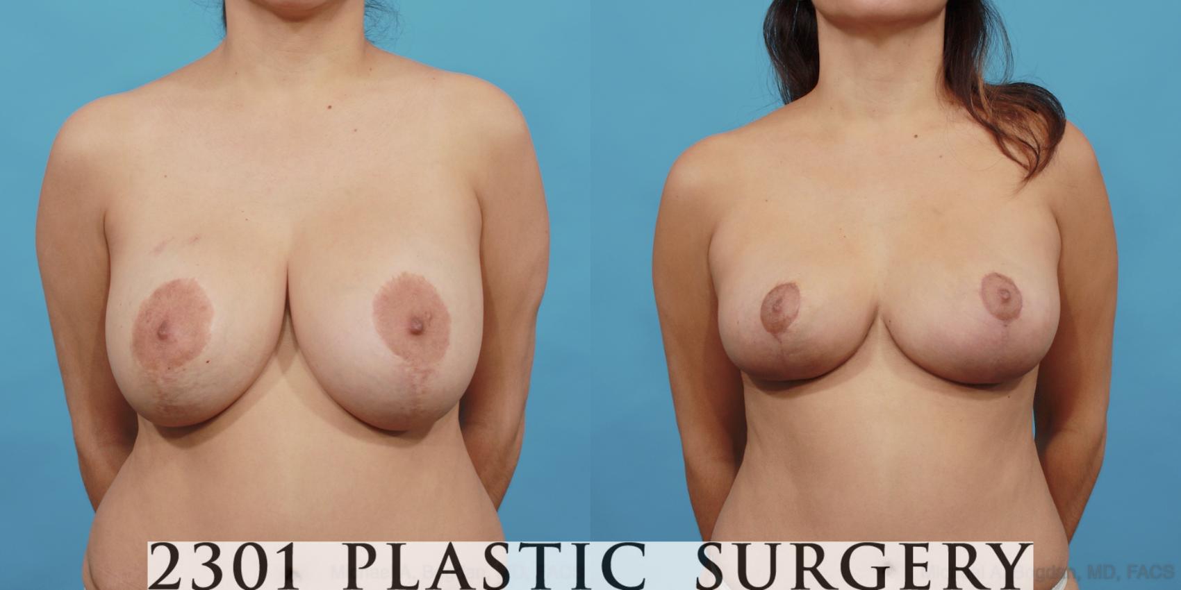 Before & After Breast Augmentation Revision Case 498 View #1 View in Fort Worth & Frisco, Texas