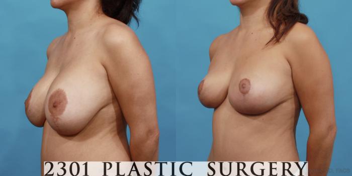 Before & After Breast Lift (Mastopexy) Case 498 View #2 View in Fort Worth, Plano, & Frisco, Texas