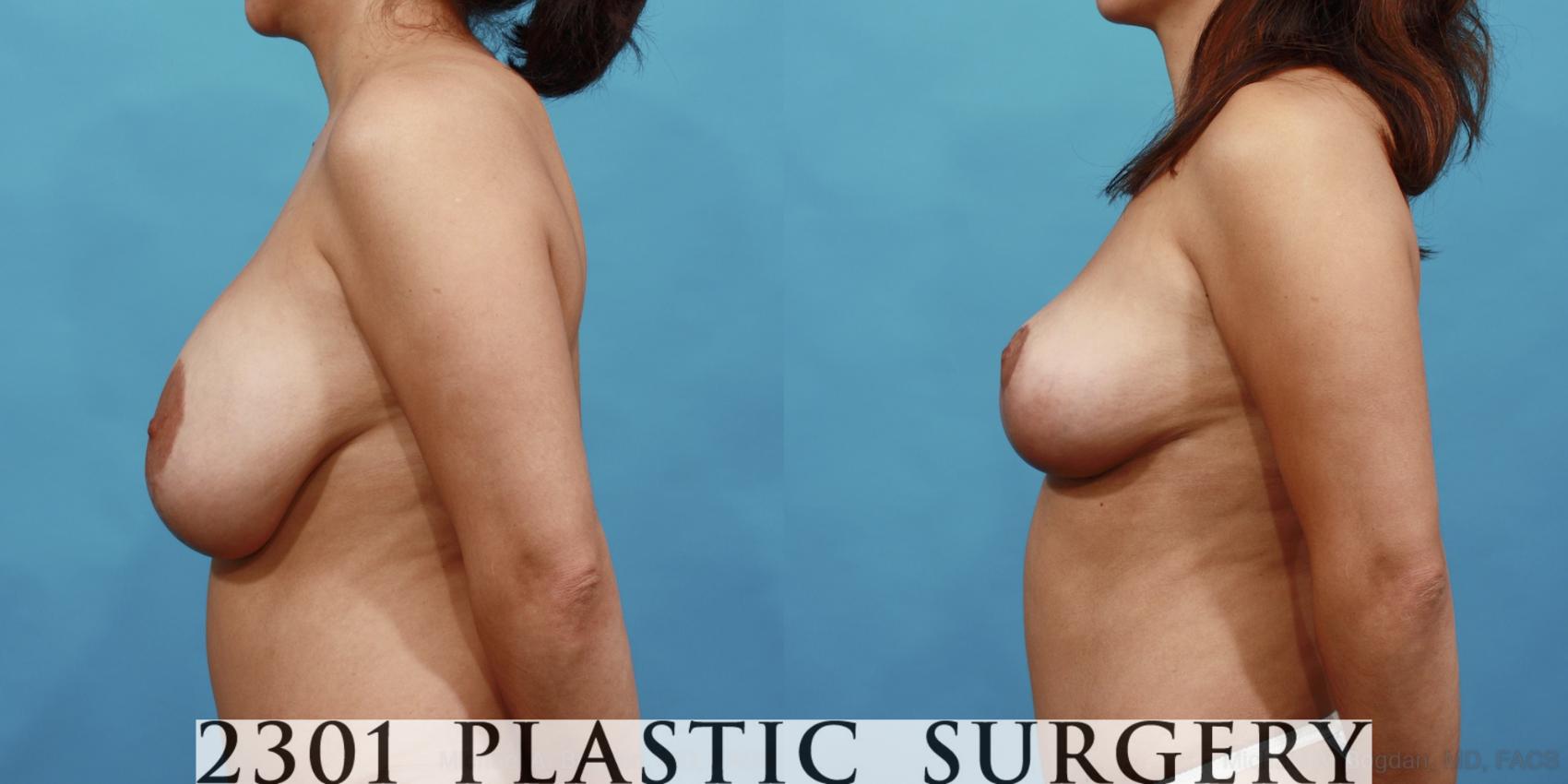 Before & After Breast Augmentation Revision Case 498 View #3 View in Fort Worth & Frisco, Texas