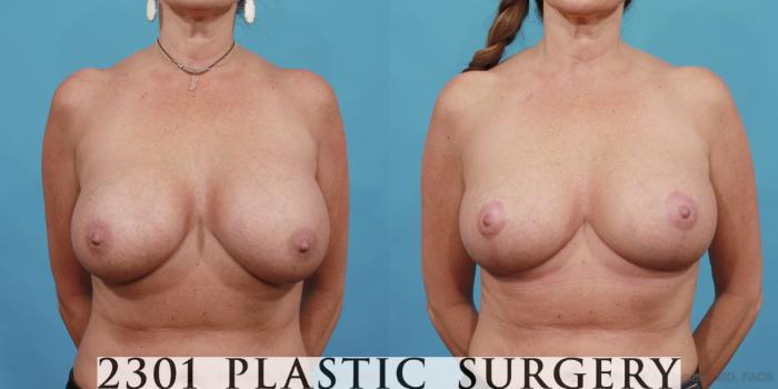 Before & After Breast Augmentation Revision Case 501 View #1 View in Fort Worth, Plano, & Frisco, Texas